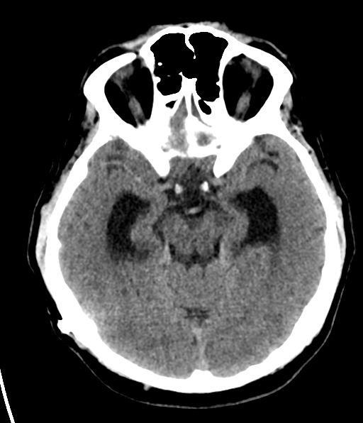 File:Aqueduct stenosis with corpus callosum hypoattenuation post shunting (Radiopaedia 37212-38973 Axial non-contrast 12).png