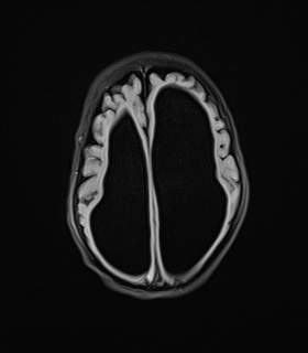 File:Aqueductal stenosis (Radiopaedia 73974-84802 Axial FLAIR 16).jpg