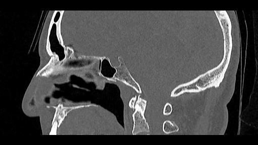Arcuate foramen (Radiopaedia 89833-106944 Sagittal bone window 52).jpg