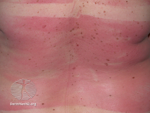 File:Around 4-7 days after exposure skin may start to peel and flake off. (DermNet NZ reactions-sunburn6).jpg