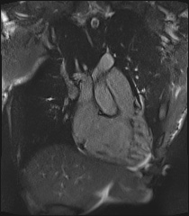 File:Arrhythmogenic right ventricular cardiomyopathy (Radiopaedia 57972-64966 CINE R2 SSFP 49).jpg