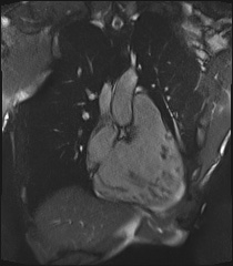 Arrhythmogenic right ventricular cardiomyopathy (Radiopaedia 57972-64966 CINE R2 SSFP 55).jpg