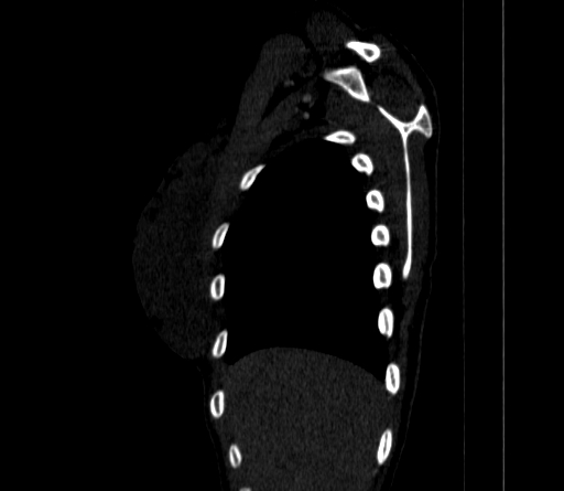 Arteria lusoria (Radiopaedia 88528-105192 C 20).jpg