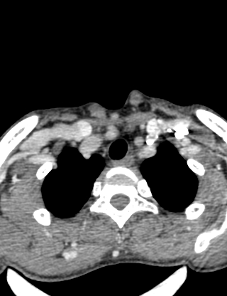 Arteriovenous malformation of the neck (Radiopaedia 53935-60062 B 47).jpg