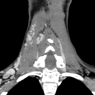Arteriovenous malformation of the neck (Radiopaedia 53935-60062 D 32).jpg