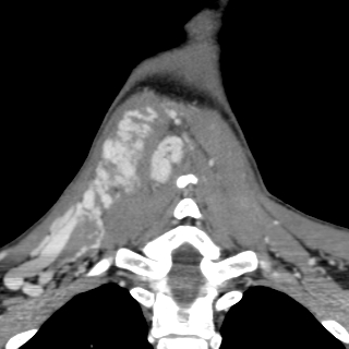 Arteriovenous malformation of the neck (Radiopaedia 53935-60062 D 42).jpg