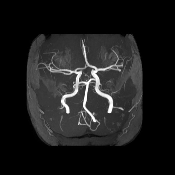 Artery of Percheron infarct (Radiopaedia 40966-43676 F 12).jpg