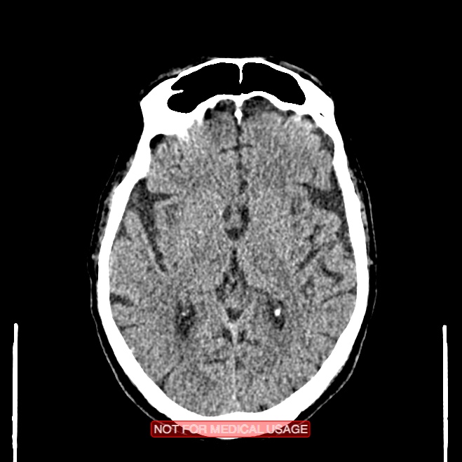Artery of Percheron infarction (Radiopaedia 28679-28967 Axial non-contrast 61).jpg