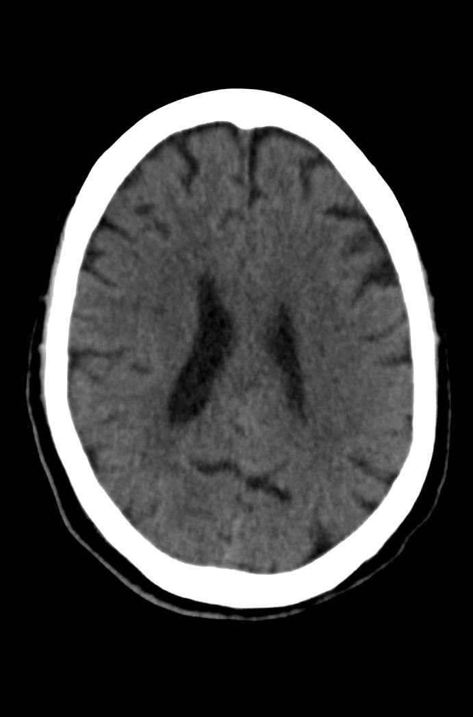 Artery of Percheron infarction (Radiopaedia 80613-94202 Axial non-contrast 123).jpg