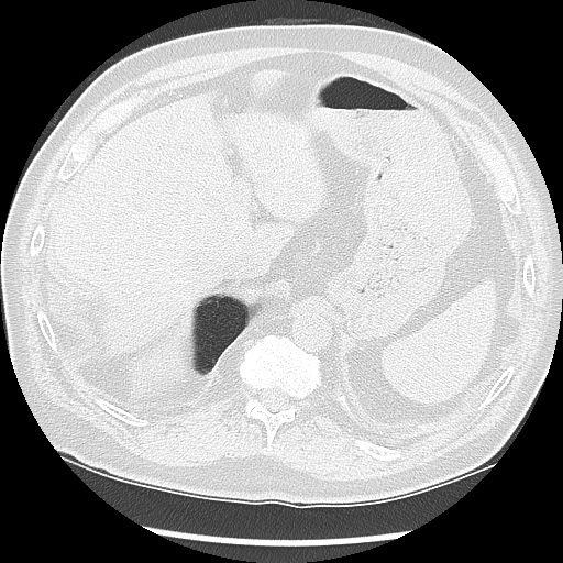 Asbestos-related pleural disease (Radiopaedia 74366-85250 Axial lung window 104).jpg