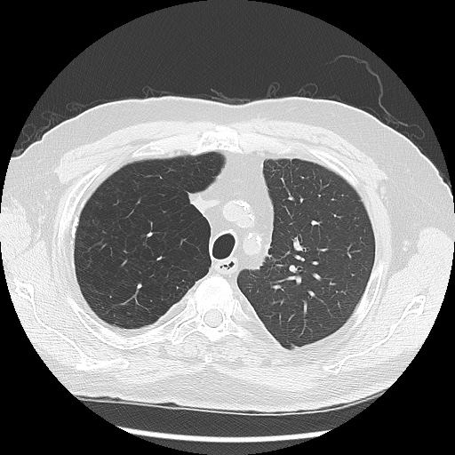 Asbestos-related pleural disease (Radiopaedia 74366-85250 Axial lung window 31).jpg