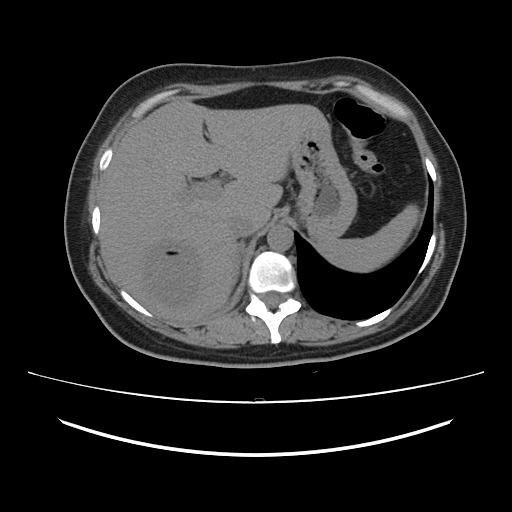 Ascending retrocecal appendicitis with liver abscesses (Radiopaedia 60066-67615 Axial non-contrast 19).jpg