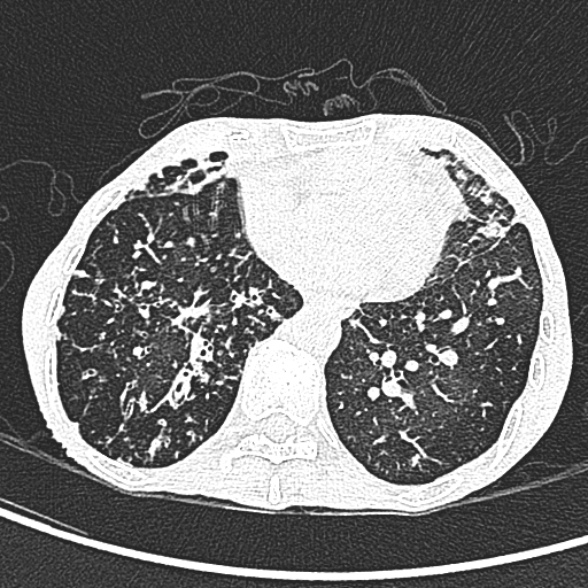 Aspergilloma- with Monod sign (Radiopaedia 44737-48532 Axial lung window 191).jpg