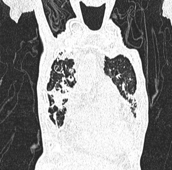 Aspergilloma- with Monod sign (Radiopaedia 44737-48532 Coronal lung window 145).jpg
