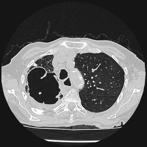 Aspergilloma (Radiopaedia 24458-24763 Axial lung window 16).jpg