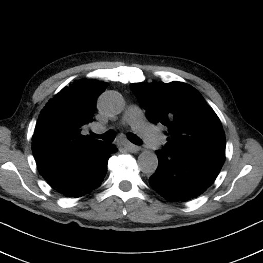 File:Aspergilloma on background pulmonary fibrosis (Radiopaedia 60942-68757 Axial non-contrast 25).jpg