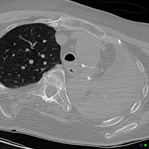 File:Aspirated food bolus obstruction of left main bronchus (Radiopaedia 29432-29904 Axial non-contrast 7).jpg