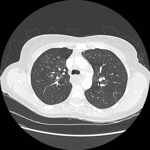 Aspiration pneumonia secondary to laparoscopic banding (Radiopaedia 18345-18183 lung window 35).jpg