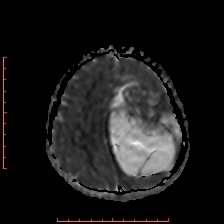 Astroblastoma (Radiopaedia 74287-85162 Axial ADC 52).jpg