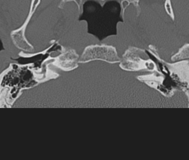 Atlanto-axial subluxation (Radiopaedia 36610-38176 Axial bone window 3).png