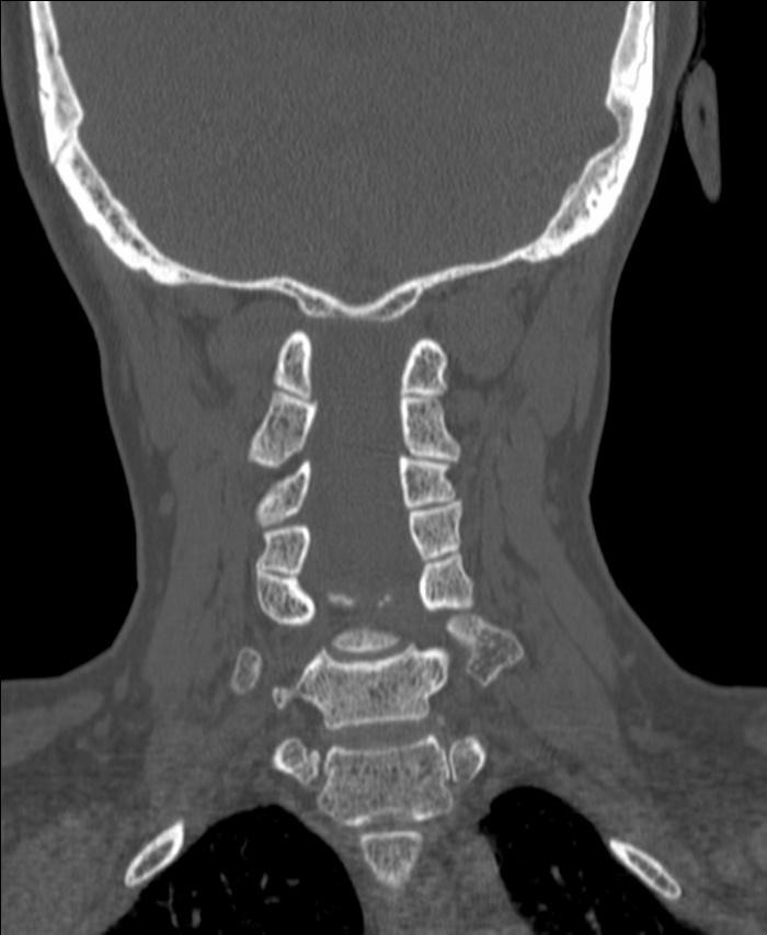 Atlanto-occipital assimilation with basilar invagination (Radiopaedia 70122-80188 Coronal bone window 138).jpg