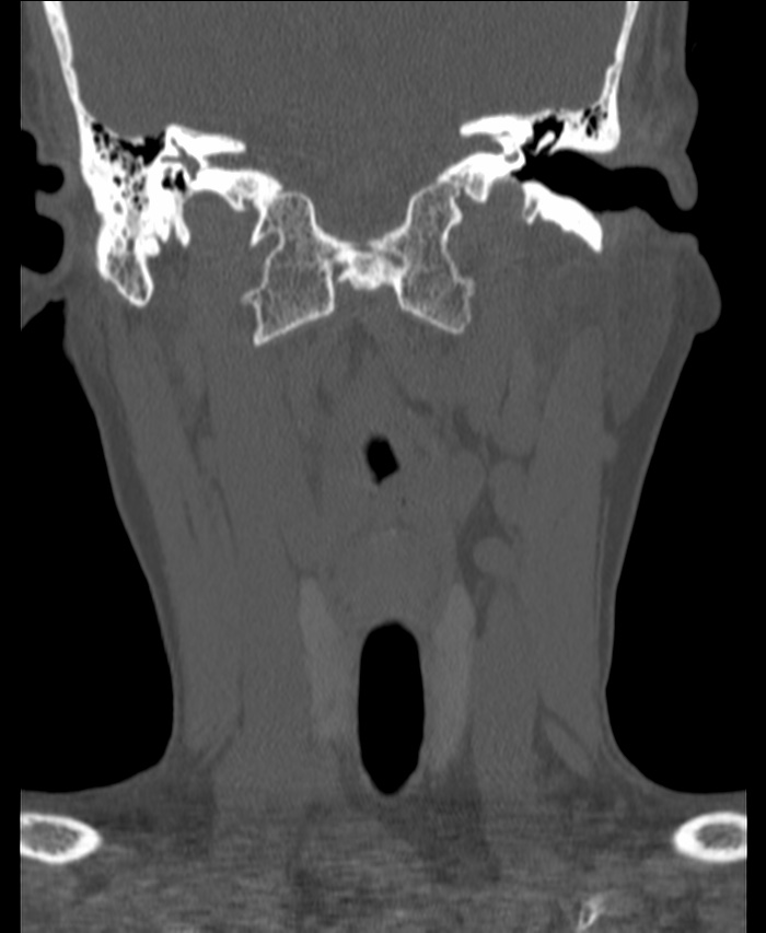 Atlanto-occipital assimilation with basilar invagination (Radiopaedia 70122-80188 Coronal bone window 51).jpg