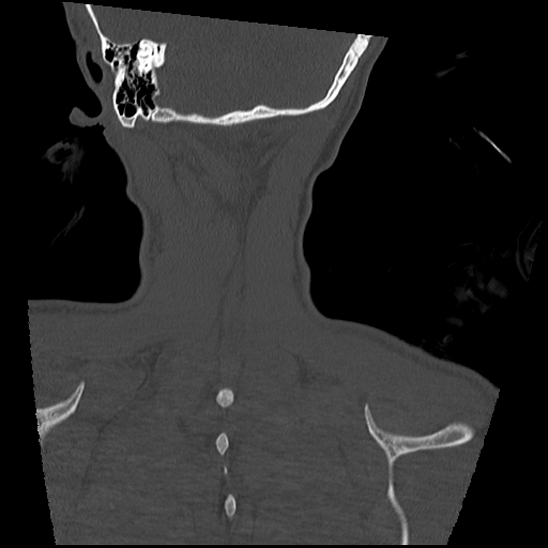 Atlanto-occipital dissociation (Traynelis type 1), C2 teardrop fracture, C6-7 facet joint dislocation (Radiopaedia 87655-104061 Coronal bone window 62).jpg