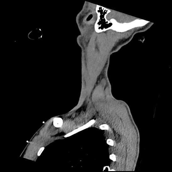 Atlanto-occipital dissociation (Traynelis type 1), C2 teardrop fracture, C6-7 facet joint dislocation (Radiopaedia 87655-104061 D 74).jpg