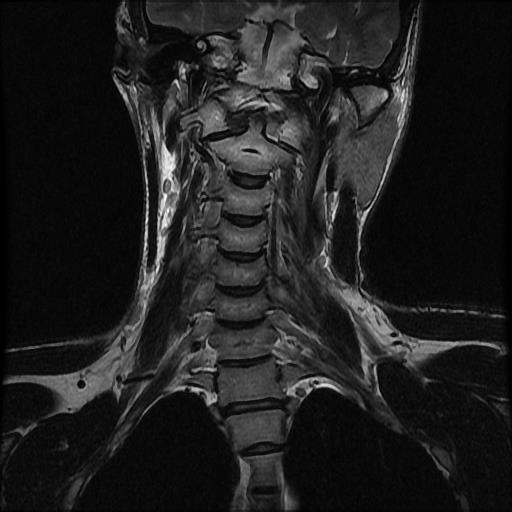 File:Atlas fracture (Radiopaedia 64277-73052 Coronal T2 7).jpg