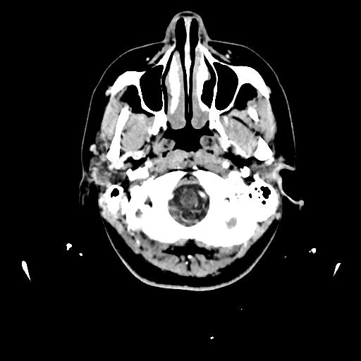 Atretic cephalocele (Radiopaedia 89782-106881 Axial with contrast 18).jpg