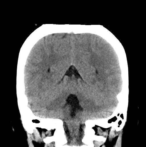 File:Atretic encephalocoele with inferior vermis hypoplasia (Radiopaedia 30443-31107 Coronal non-contrast 28).jpg