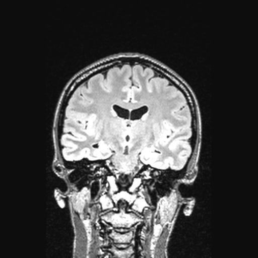 Atretic encephalocoele with inferior vermis hypoplasia (Radiopaedia 30443-31108 Coronal FLAIR 94).jpg