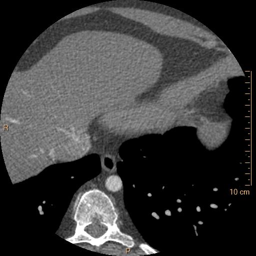 File:Atrial septal defect (upper sinus venosus type) with partial anomalous pulmonary venous return into superior vena cava (Radiopaedia 73228-83961 A 251).jpg