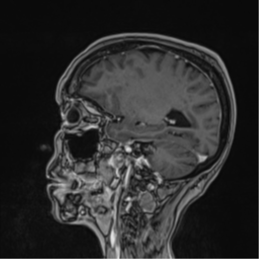 Atypical meningioma (WHO Grade II) (Radiopaedia 54742-60979 Sagittal T1 C+ 26).png