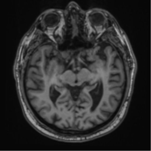 File:Atypical meningioma (WHO grade II) with brain invasion (Radiopaedia 57767-64729 Axial T1 21).png