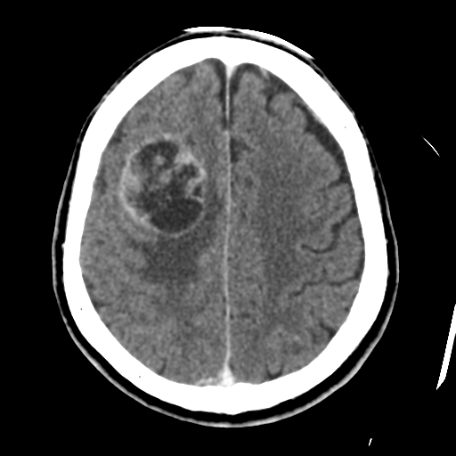 Atypical meningioma (WHO grade II) with osseous invasion (Radiopaedia 53654-59715 Axial C+ delayed 38).png