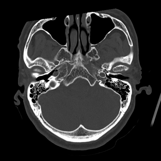 Atypical meningioma (WHO grade II) with osseous invasion (Radiopaedia 53654-59715 Axial bone window 18).png