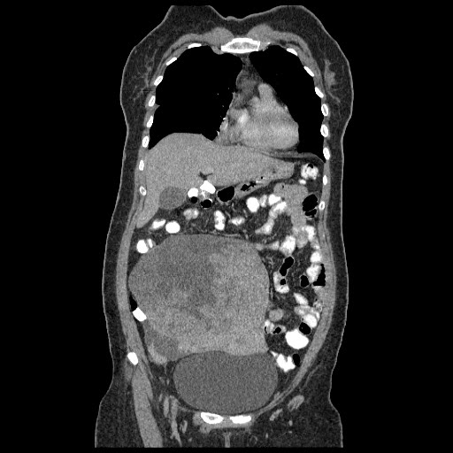 File:Atypical retroperitoneal lymphocoeles with large leiomyoma of uterus (Radiopaedia 32084-33024 B 6).jpg