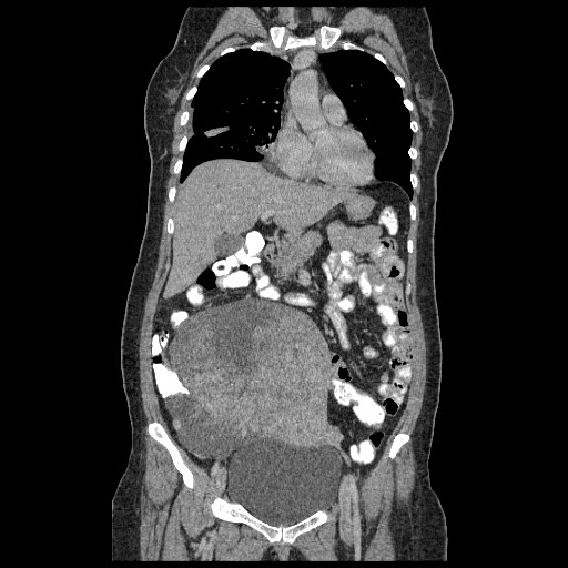 File:Atypical retroperitoneal lymphocoeles with large leiomyoma of uterus (Radiopaedia 32084-33024 B 8).jpg