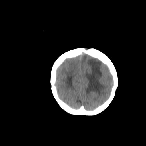 Atypical teratoid rhabdoid tumor (AT-RT) (Radiopaedia 85823-101654 Coronal non-contrast 50).jpg