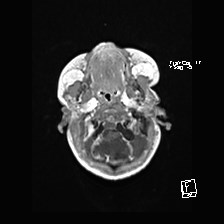 Atypical teratoid rhabdoid tumor (prenatal US and neonatal MRI) (Radiopaedia 59091-66388 Axial T1 C+ 9).jpg