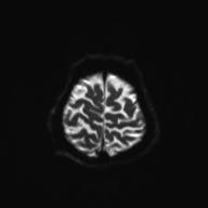 File:Autoimmune limbic encephalitis (Radiopaedia 30363-31005 Axial B0 and DWI 29).jpg