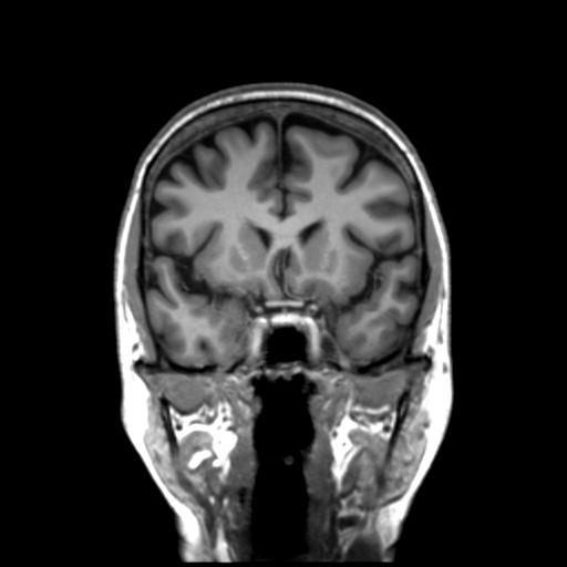 Autoimmune limbic encephalitis (Radiopaedia 30363-31005 Coronal T1 37).jpg