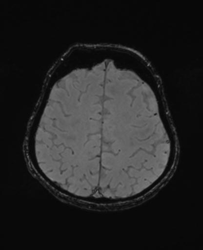 Autoimmune limbic encephalitis (Radiopaedia 30363-31005 SWI - magnitude 60).jpg