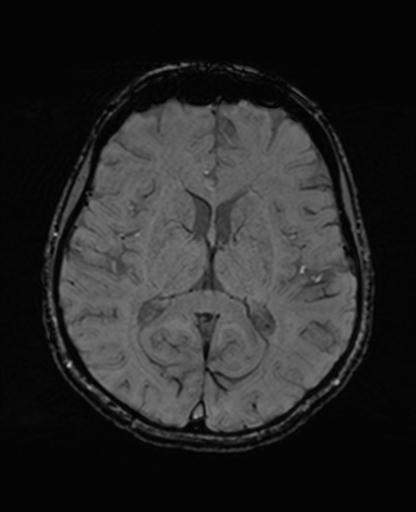 Autoimmune limbic encephalitis (Radiopaedia 30363-31005 SWI 43).jpg