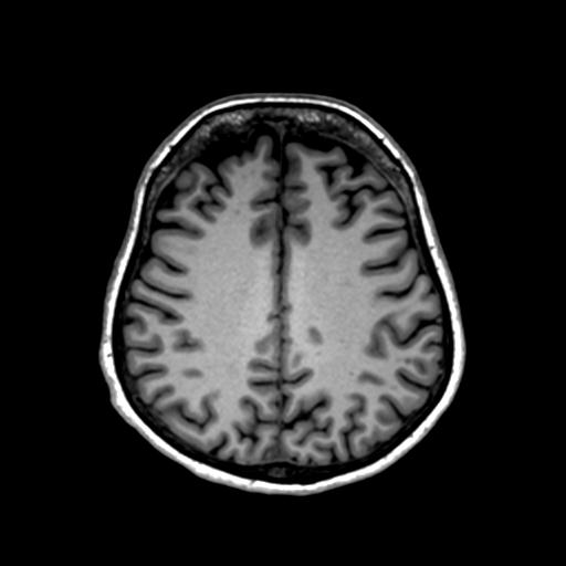 File:Autoimmune limbic encephalitis (Radiopaedia 30363-31005 T1 Axial 1mm 104).jpg