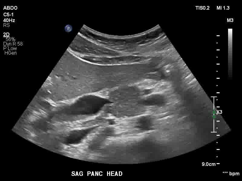 File:Autoimmune pancreatitis (Radiopaedia 88443-105100 C 20).jpg