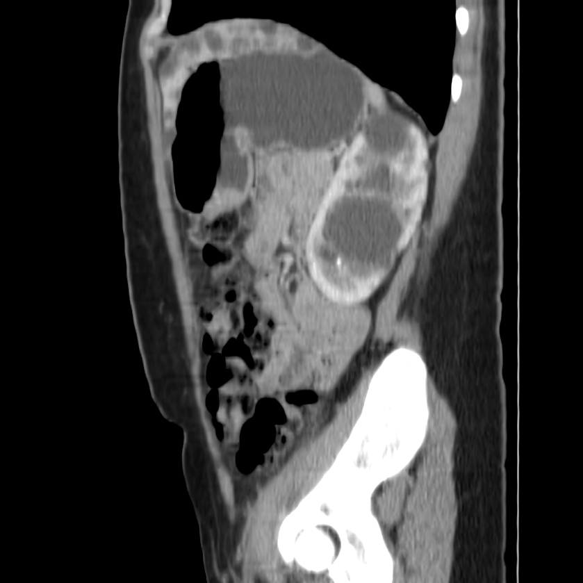 Autosomal dominant polycystic kidney disease (Radiopaedia 23061-23093 F 41).jpg