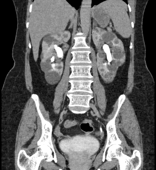 Autosomal dominant polycystic kidney disease (Radiopaedia 38189-40194 Coronal C+ delayed 57).jpg