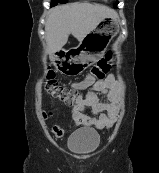 Autosomal dominant polycystic kidney disease (Radiopaedia 38189-40194 Coronal C+ delayed 7).jpg